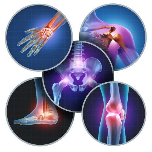 Arthritic Pain & Inflammation